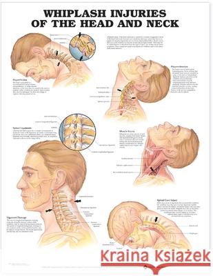 Whiplash Injuries of the Head and Neck Anatomical Chart  Anatomical Chart Company 9781587793752 0