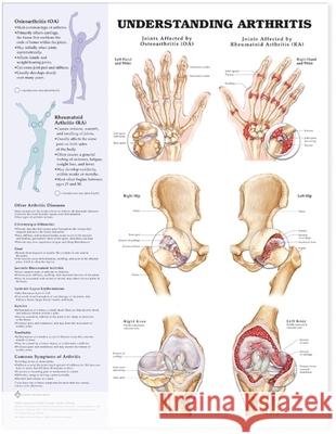 Understanding Arthritis Anatomical Chart  Anatomical Chart Company 9781587793851 0