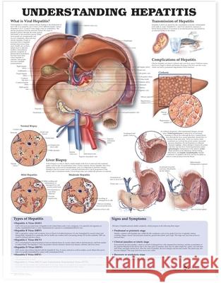 Understanding Hepatitis Anatomical Chart  9781587794186 ANATOMICAL CHART CO ,U.S.