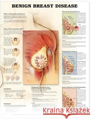 Benign Breast Disease Anatomical Chart  9781587796739 ANATOMICAL CHART CO ,U.S.