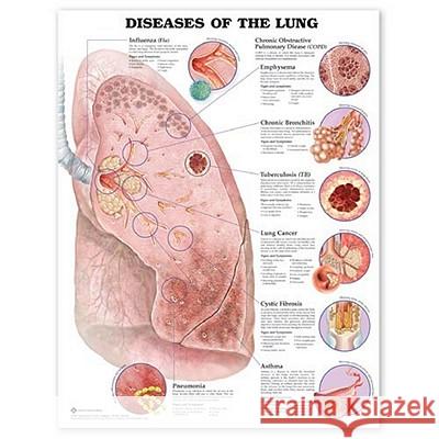 Diseases of the Lung Anatomical Chart  Anatomical Chart Company 9781587799082 0