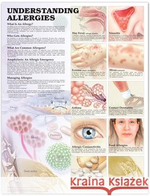 UNDERSTANDING ALLERGIES ANATOMICAL CHART  9781587799402 ANATOMICAL CHART CO ,U.S.