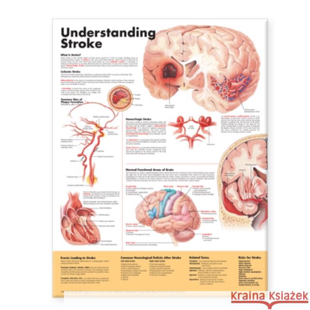 Understanding Stroke Anatomical Chart  Anatomical Chart Company 9781587799884 0