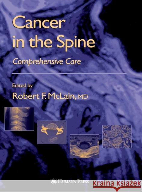 Cancer in the Spine: Comprehensive Care McLain, Robert F. 9781588290748 Humana Press