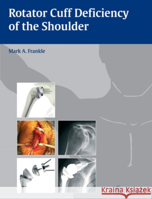 Rotator Cuff Deficiency of the Shoulder M. A. Frankle Mark A. Frankle Mark A. Frankle 9781588905062 Thieme Medical Publishers