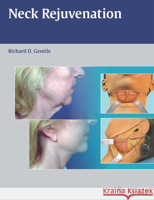 Neck Rejuvenation Gentile 9781604060560 Thieme Medical Publishers