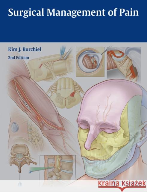 Surgical Management of Pain Kim J. Burchiel 9781604067514 Thieme Medical Publishers