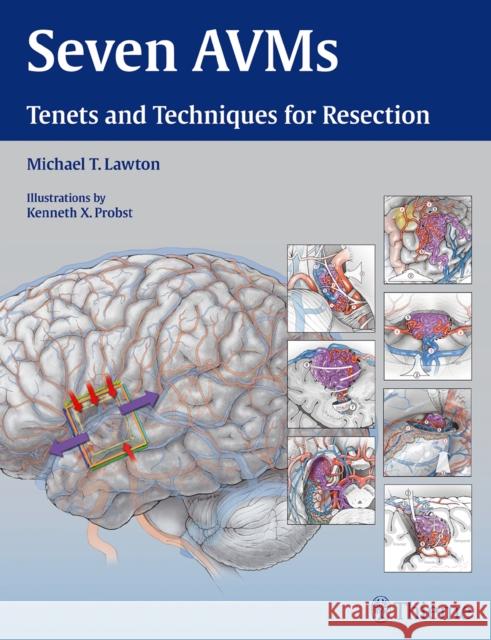 Seven Avms: Tenets and Techniques for Resection Lawton, Michael T. 9781604068757 Thieme Medical Publishers