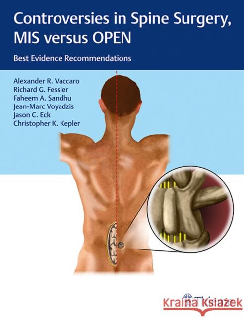Controversies in Spine Surgery, MIS Versus Open: Best Evidence Recommendations Vaccaro, Alexander R. 9781604068818 Thieme Medical Publishers