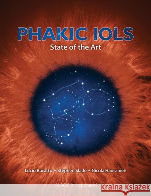 Phakic Iols: State of the Art Buratto, Lucio 9781617110610