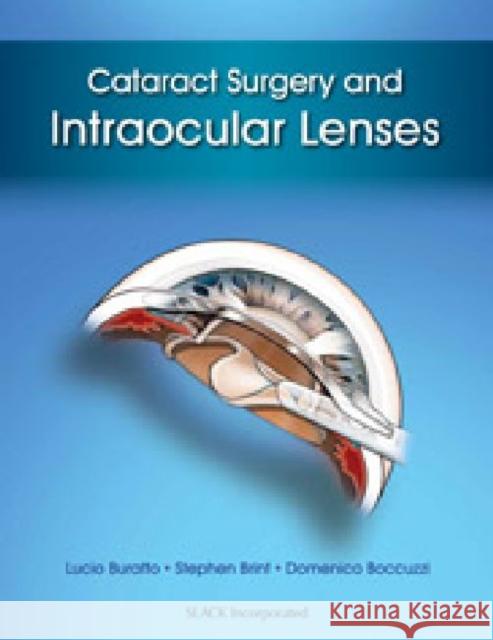 Cataract Surgery and Intraocular Lenses Lucio Buratto Stephen Brint Domenico Boccuzzi 9781617116049 Slack