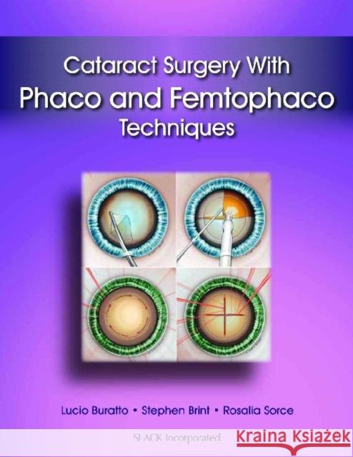 Cataract Surgery with Phaco and Femtophaco Techniques Lucio Buratto Stephen Brint Rosalia Sorce 9781617116063 Slack