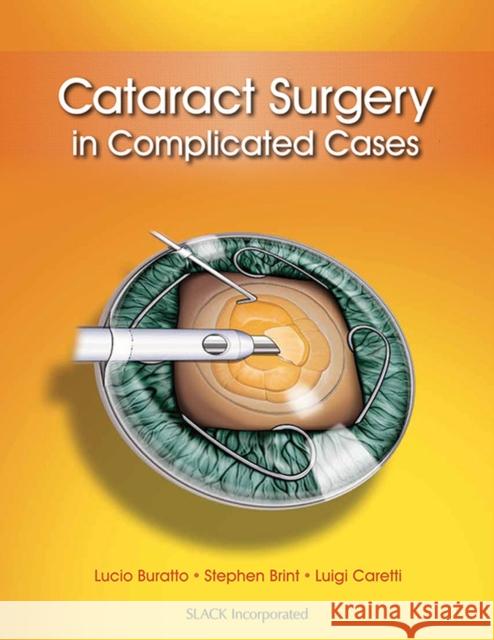 Cataract Surgery in Complicated Cases Lucio Buratto Stephen Brint Luigi Caretti 9781617116070 Slack