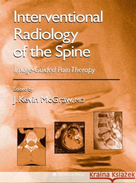 Interventional Radiology of the Spine: Image-Guided Pain Therapy McGraw, J. Kevin 9781617374197 Springer