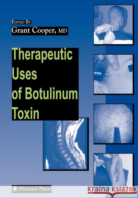 Therapeutic Uses of Botulinum Toxin Grant C. Cooper 9781617378423