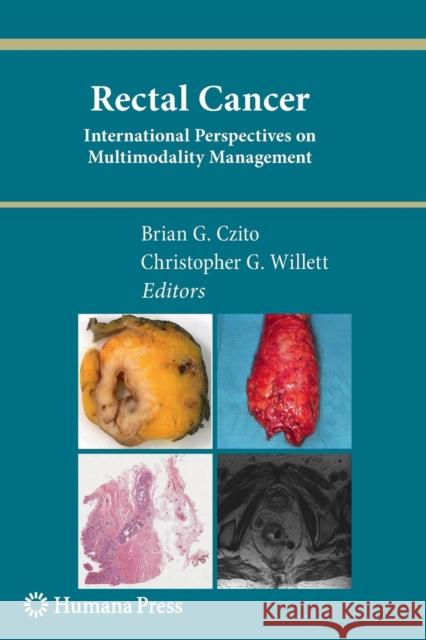 Rectal Cancer: International Perspectives on Multimodality Management Czito, Brian G. 9781617796951 Humana Press