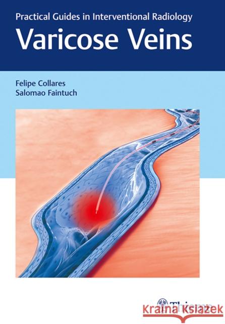 Varicose Veins: Practical Guides in Interventional Radiology Felipe Collares Salomaao Faintuch 9781626230125 Thieme Medical Publishers