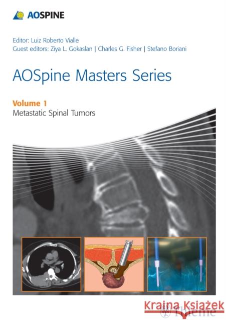 Aospine Masters Series Volume 1: Metastatic Spinal Tumors Vialle, Luiz Roberto Gomes 9781626230460 Thieme Medical Publishers
