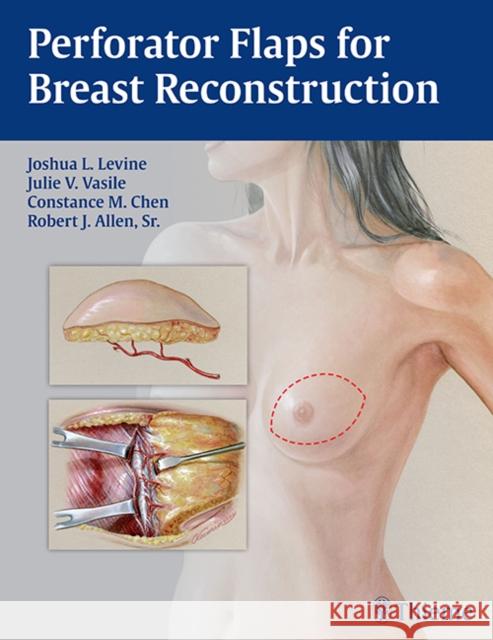 Perforator Flaps for Breast Reconstruction Joshua L. Levine Julie V. Vasile Connie Chen 9781626230941 Thieme Medical Publishers