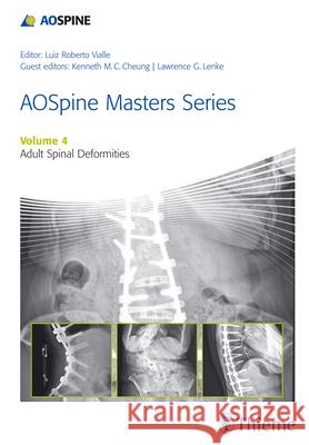 Aospine Master Series, Vol. 4: Adult Spinal Deformities Lenke, Lawrence G. 9781626231009