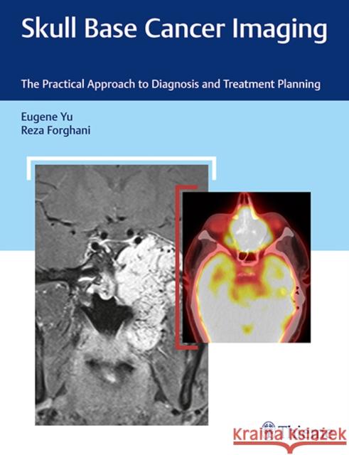 Skull Base Cancer Imaging: The Practical Approach to Diagnosis and Treatment Planning Yu, Eugene 9781626232969 Thieme Medical Publishers