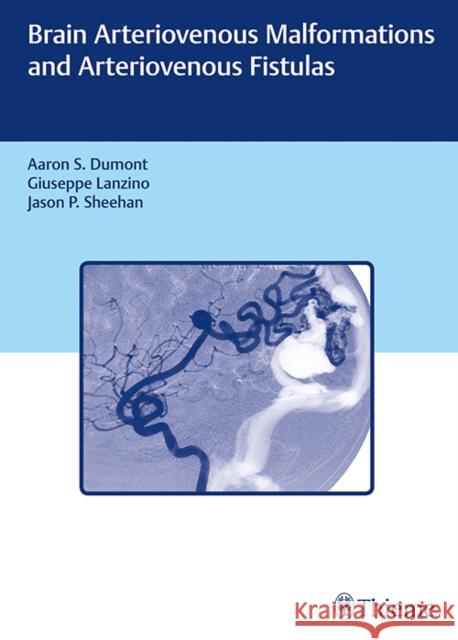 Brain Arteriovenous Malformations and Arteriovenous Fistulas Aaron S. Dumont Jason P. Sheehan Giuseppe Lanzino 9781626233225 Thieme Medical Publishers