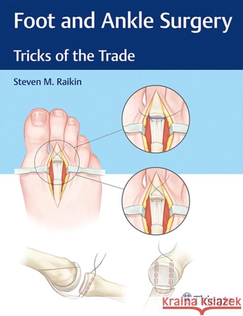 Foot and Ankle Surgery: Tricks of the Trade Raikin, Steven M. 9781626234918 Thieme Medical Publishers