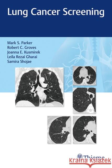 Lung Cancer Screening Mark Parker Robert Groves Joanna Kusmirek 9781626235137 Thieme Medical Publishers