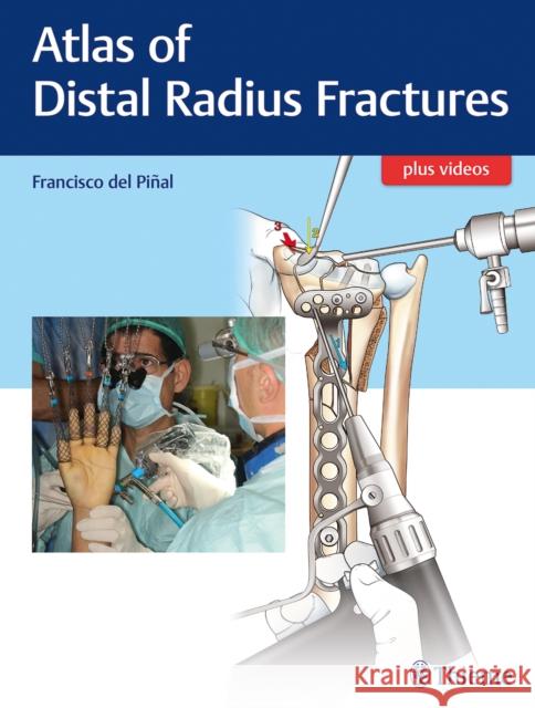 Atlas of Distal Radius Fractures Francisco De 9781626236790 Thieme Medical Publishers