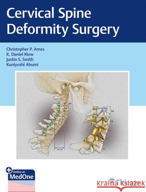 Cervical Spine Deformity Surgery Ames, Christopher P. 9781626239012 Thieme Medical Publishers