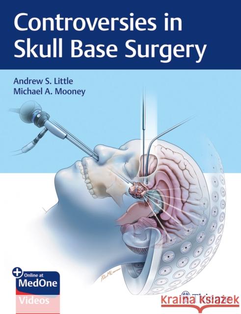 Controversies in Skull Base Surgery Little, Andrew S. 9781626239531 Thieme Medical Publishers