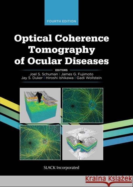 Optical Coherence Tomography of Ocular Diseases Joel Schuman 9781630917081