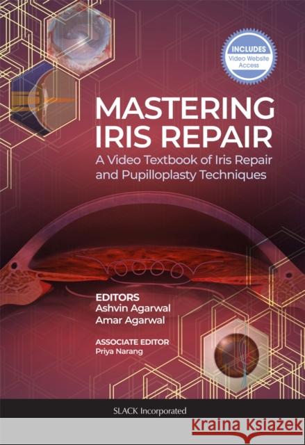Mastering Iris Repair: A Video Textbook of Iris Repair and Pupilloplasty Techniques Ashvin Agarwal Amar Agarwal 9781630917265 