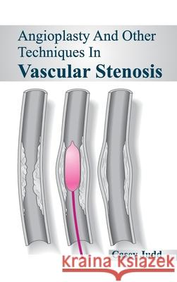 Angioplasty and Other Techniques in Vascular Stenosis Casey Judd 9781632420480 Foster Academics