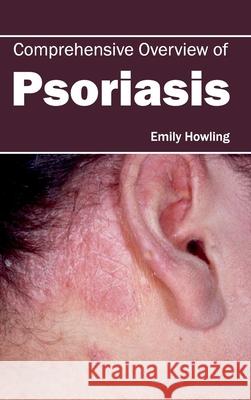 Comprehensive Overview of Psoriasis Emily Howling 9781632420893 Foster Academics