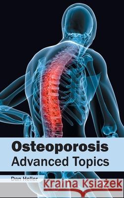 Osteoporosis: Advanced Topics Dan Heller 9781632423054 Foster Academics