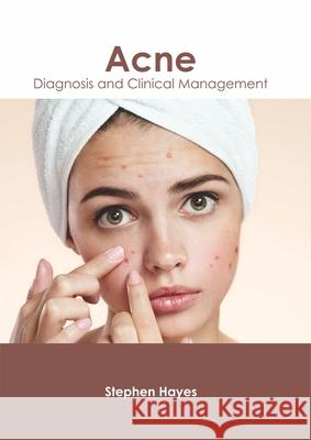 Acne: Diagnosis and Clinical Management Stephen Hayes 9781632426178 Foster Academics