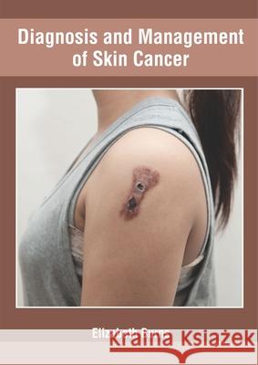 Diagnosis and Management of Skin Cancer Elizabeth Burns 9781632427472 Foster Academics