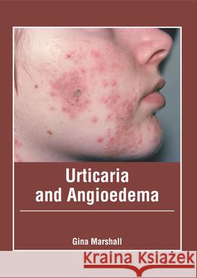 Urticaria and Angioedema Gina Marshall 9781632429247