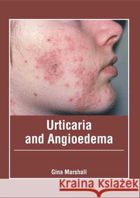 Urticaria and Angioedema Gina Marshall 9781632429247 Foster Academics