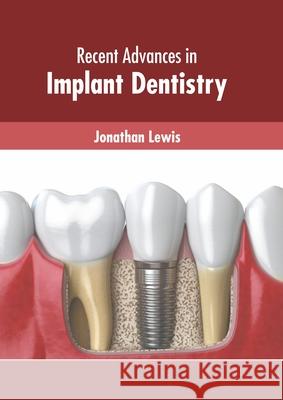 Recent Advances in Implant Dentistry Jonathan Lewis 9781639874767