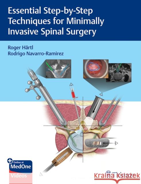 Essential Step-By-Step Techniques for Minimally Invasive Spinal Surgery Roger Hartl Rodrigo Navarro-Ramirez 9781684200092