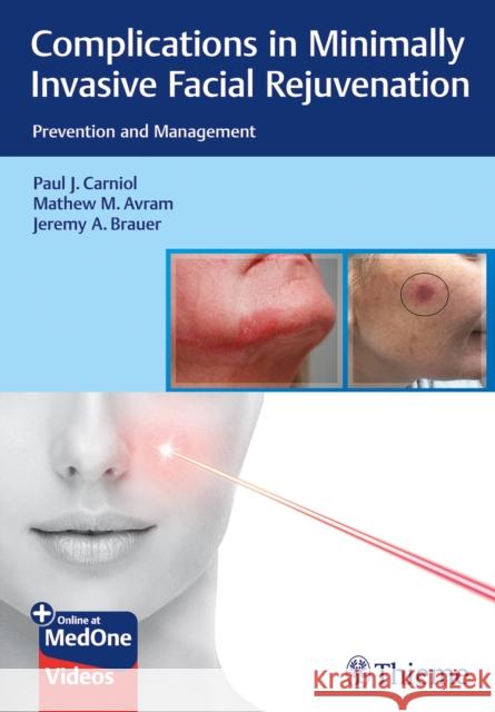Complications in Minimally Invasive Facial Rejuvenation: Prevention and Management Paul Carniol Mathew M. Avram Jeremy A. Brauer 9781684200139 Thieme Medical Publishers