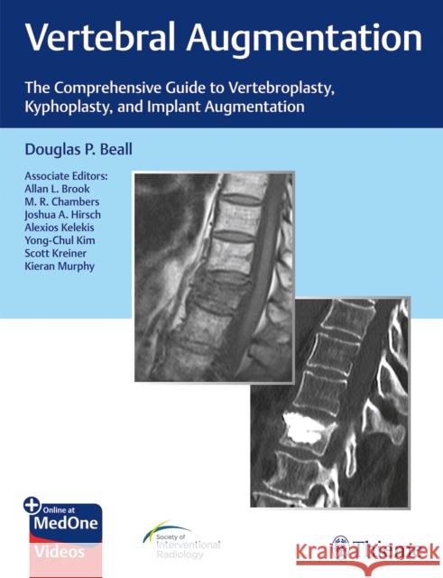 Vertebral Augmentation: The Comprehensive Guide to Vertebroplasty, Kyphoplasty, and Implant Augmentation Beall, Douglas P. 9781684200153