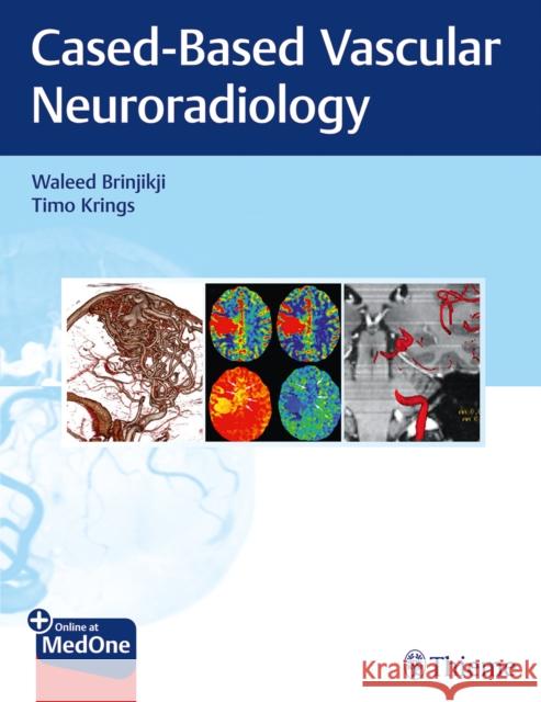 Imaging in Neurovascular Disease: A Case-Based Approach Brinjikji, Waleed 9781684200535 Thieme Medical Publishers