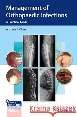 Management of Orthopaedic Infections: A Practical Guide Antonia Chen 9781684201334