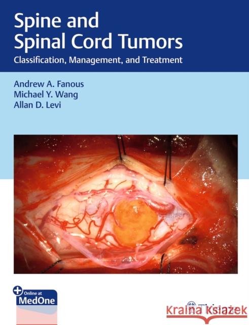 Spine and Spinal Cord Tumors: Classification, Management, and Treatment Andrew Fanous Michael Wang Allan Levi 9781684201631 Thieme Medical Publishers