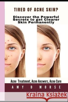 TIRED OF ACNE SKIN? Discover the Powerful Secrets to get clearer skin Permanently Amy D. Morse 9781712165232 Independently Published