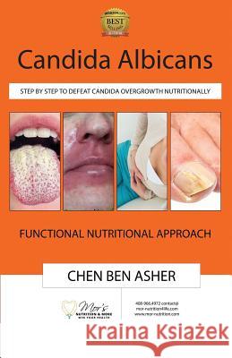 Candida Albicans: Step by Step to Defeat Candida Overgrowth Nutritionally Chen Be 9781720821540