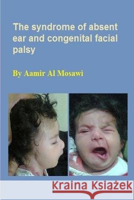 The syndrome of absent ear and congenital facial palsy: Clinical dysmorphology Al Mosawi, Aamir Jalal 9781729755488